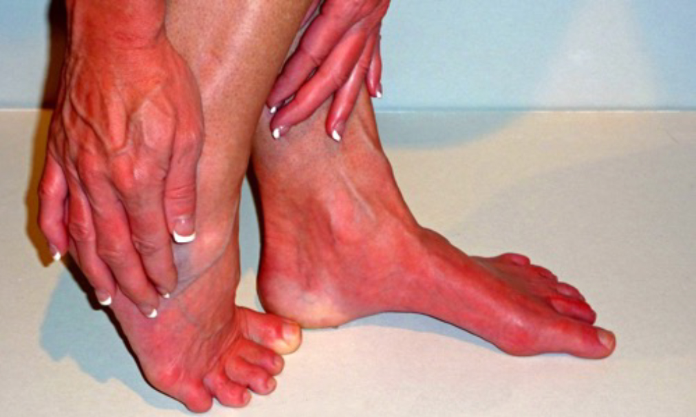 Erythromelalgia Pila Pharma