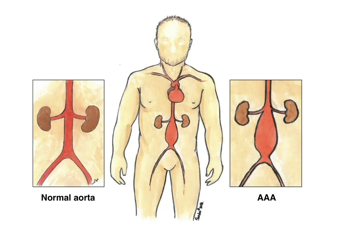Abdominal aortic aneurysm